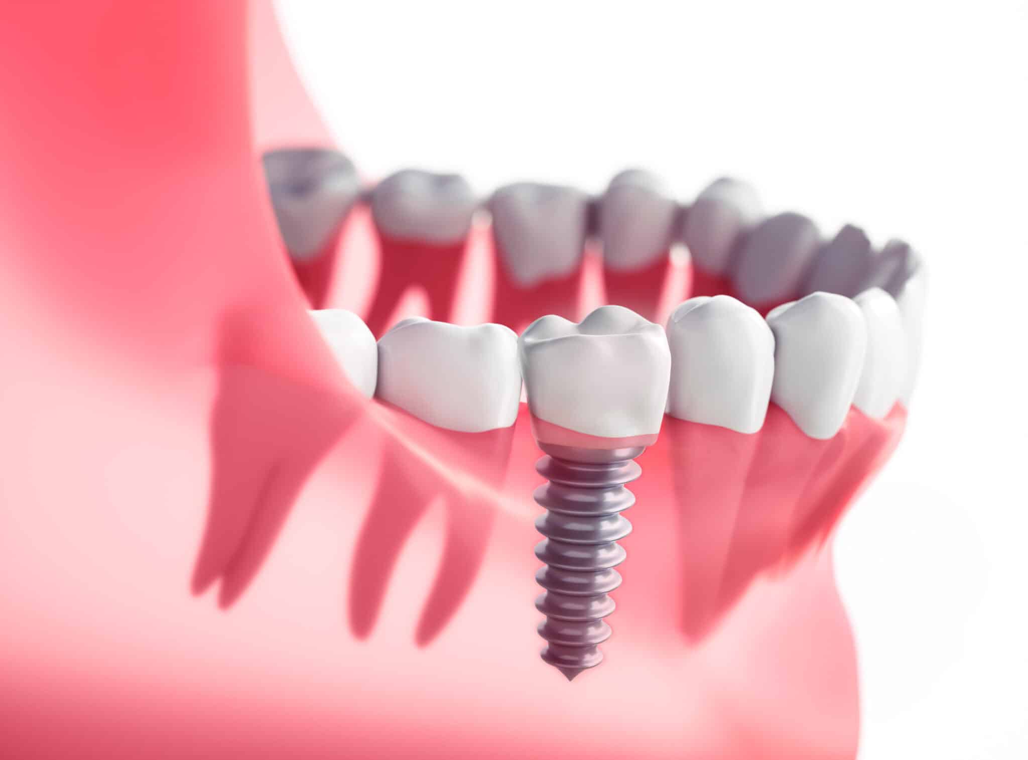 Implant dentaire